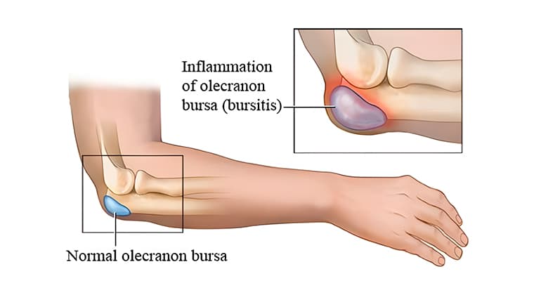 Bursitis