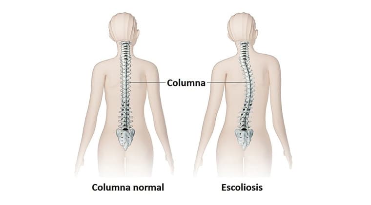 Escoliosis