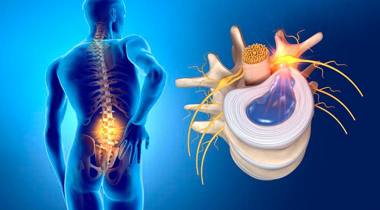 Hernias Discales
