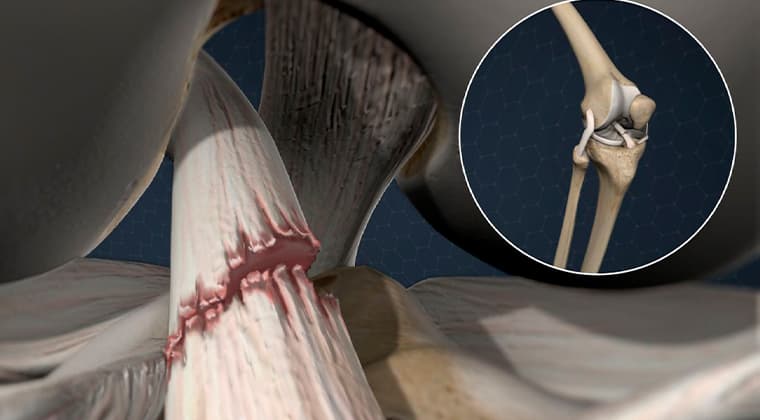 Lesiones Deportivas de Rodilla y Hombro