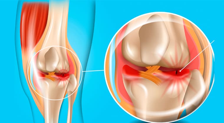 Lesiones Meniscales