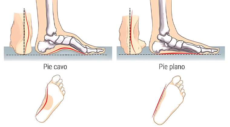 Pie Plano o Pie Cavo