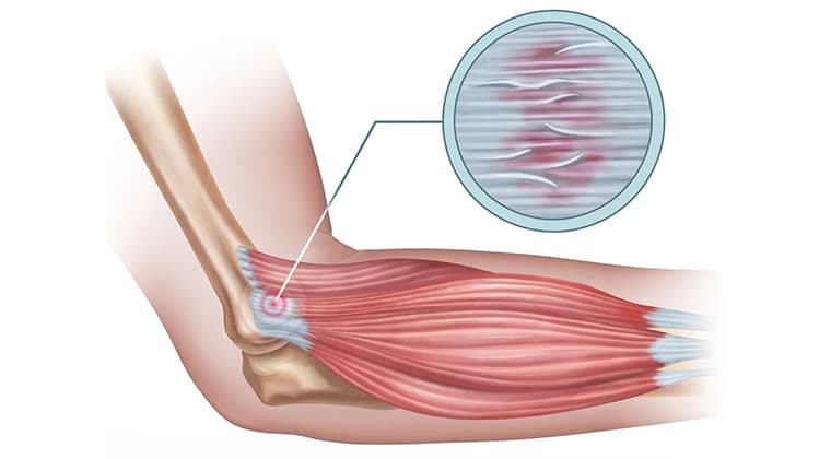 Tendinitis