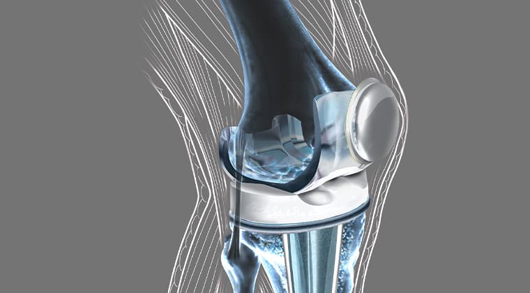 Prótesis de Rodilla